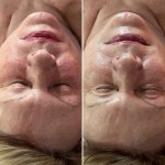 Custom Facial with Jelly Mask, and Oxygen Treatment.