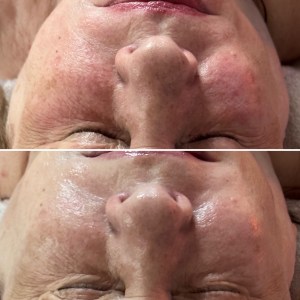 Custom Facial for Redness and Inflamation