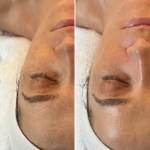 Custom Facial with Peel