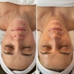 Facial with Peel and Oxygen Treatment