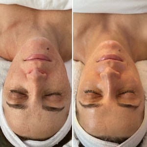 Facial with Peel and Oxygen Treatment