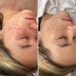 Acne Facial