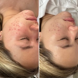 Acne Facial