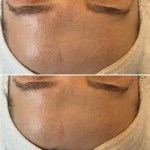 Custom Facial with Peel