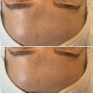 Custom Facial with Peel