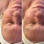 Custom Facial with Jelly Mask and Oxygen Treatment