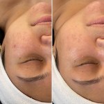 Custom Facial