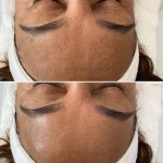 Custom Facial with Peel