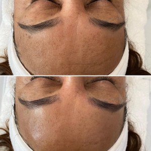 Custom Facial with Peel