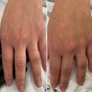Hand Treatment