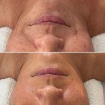 Custom Facial with Peel