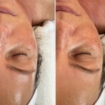 Custom Facial with Peel