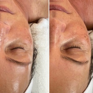 Custom Facial with Peel
