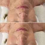 Custom Facial Anti-Aging