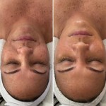 Custom Facial with Peel