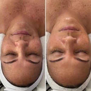 Custom Facial with Peel