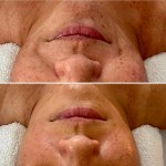 Custom Facial with Peel