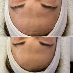 Custom Facial with Peel
