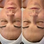 Custom Facial with Peel