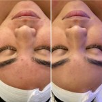 Teen Facial