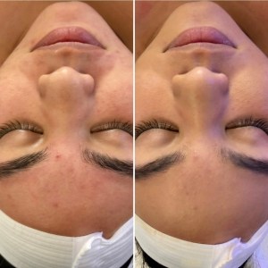 Teen Facial