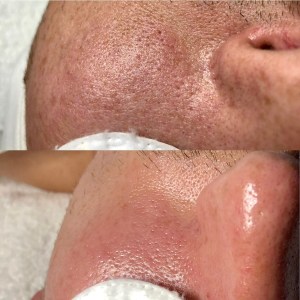 Custom Facial with Peel
