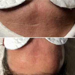 Custom Facial with Peel